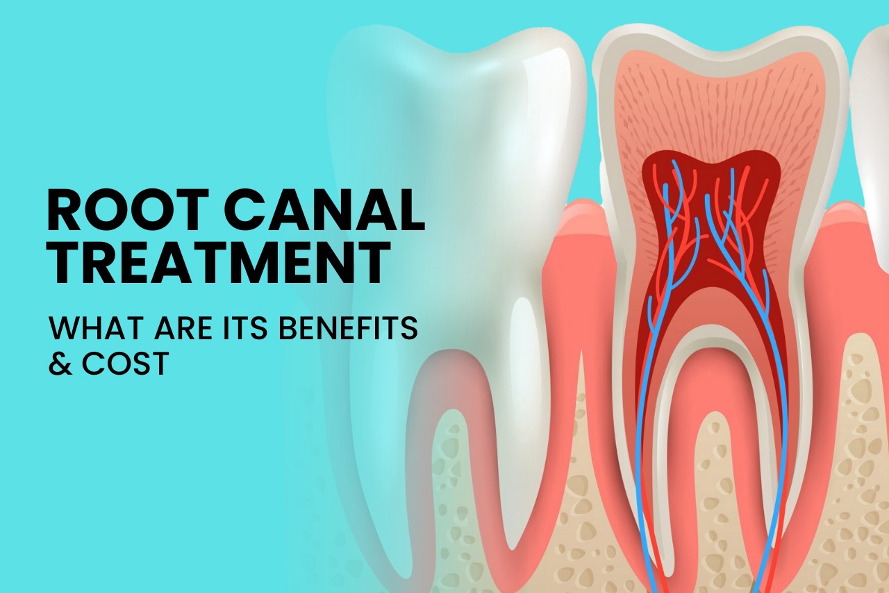 Root Canal Treatment: What are its Benefits & Cost